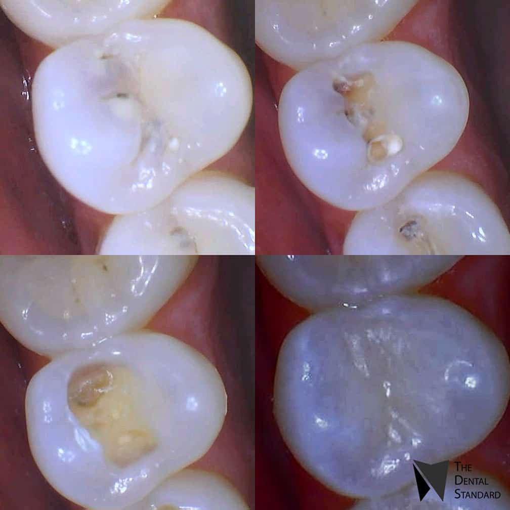 teeth cavities before and after