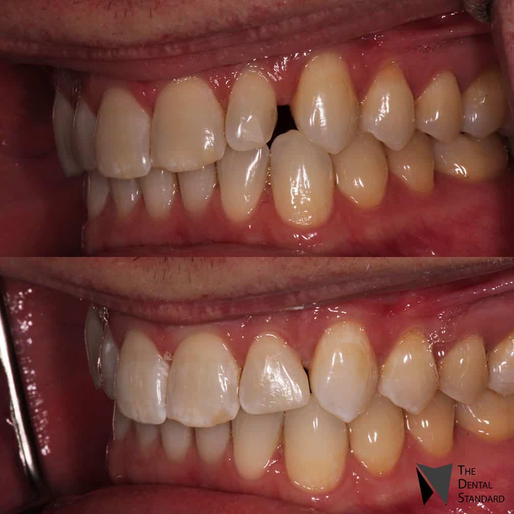 teeth composite veneers before and after