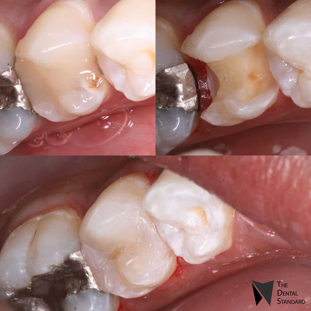 tooth filling before and after