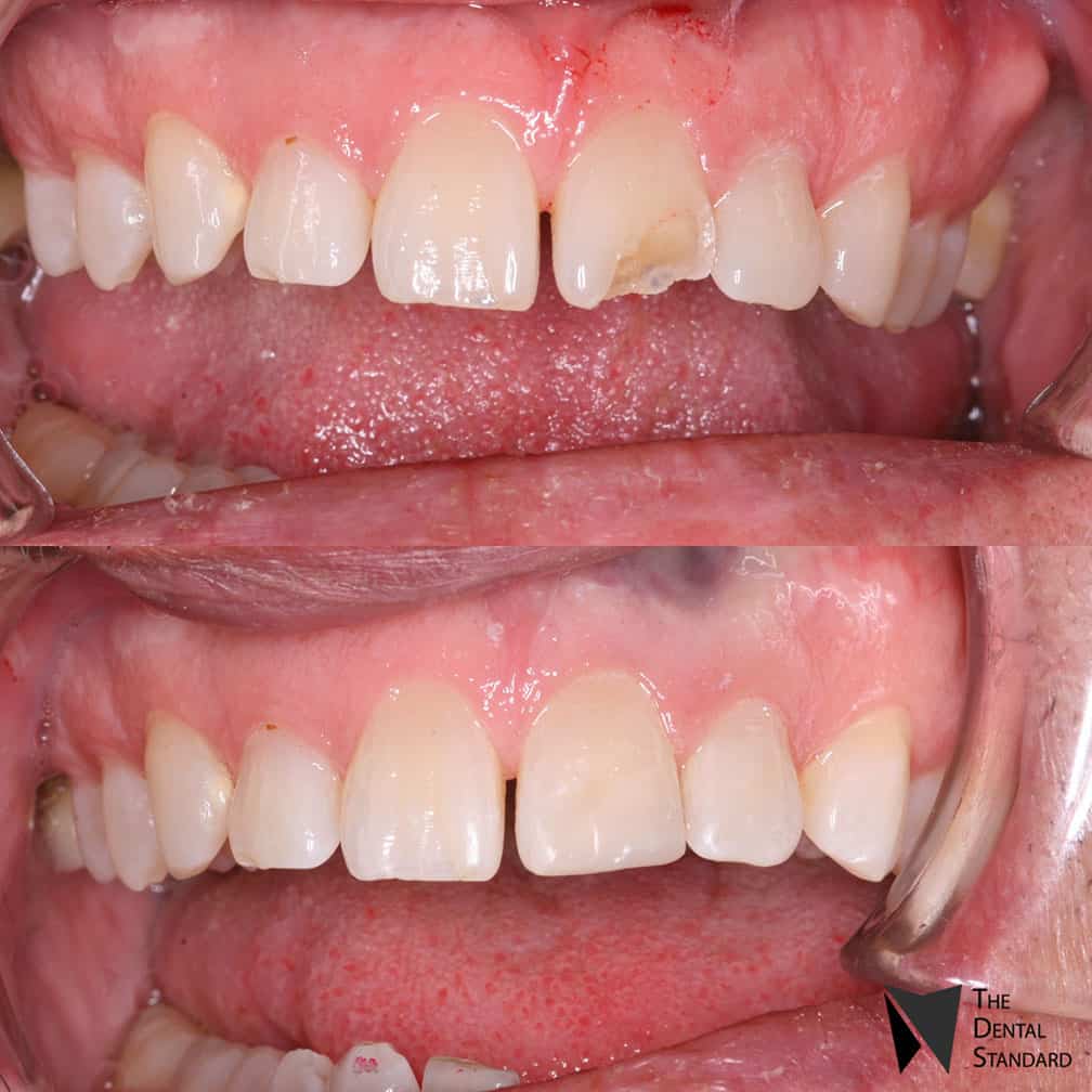 chipped tooth repair before and after